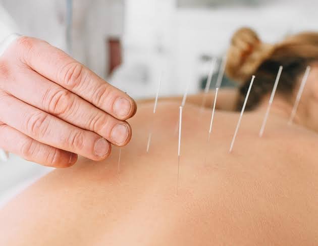 Acupuncture